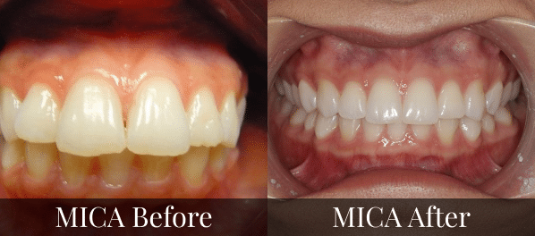 Removing Invisalign Buttons the Right Way - Seasons of Smiles