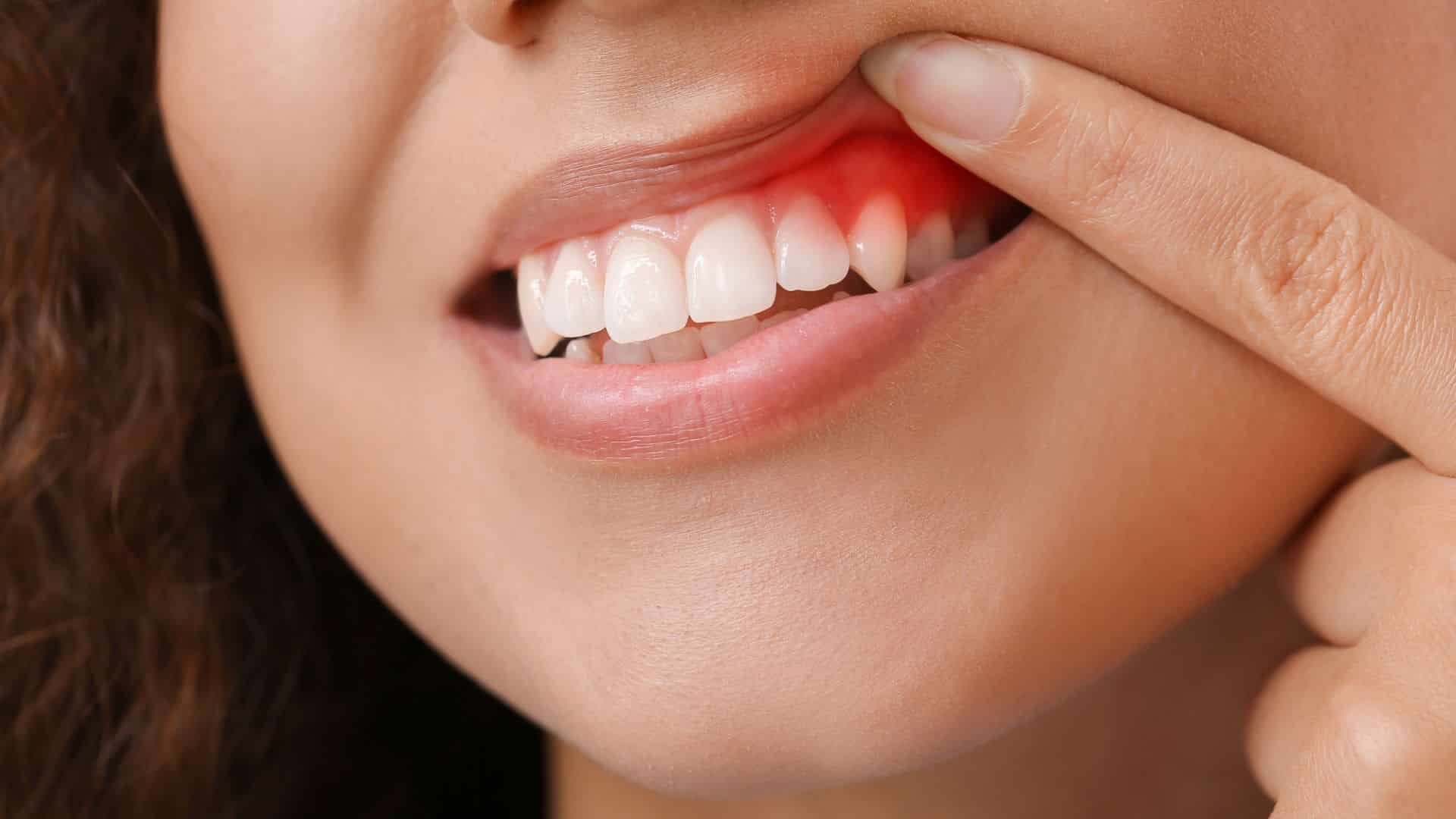 How to Cure Gum Disease without a Dentist