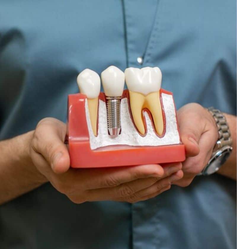 Showing dental implants for missing tooth replacement