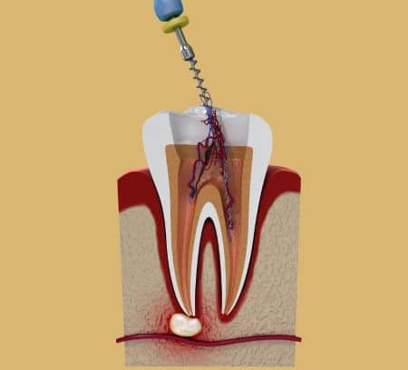 Root canal treatment shown with a graphic